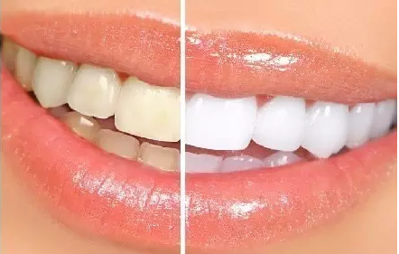 瓷贴面需要修整牙齿吗?不磨牙贴面就比较好吗?