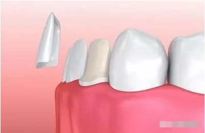 牙齿贴面有哪些优点?值得选择吗?