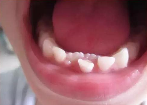 小孩子矫正牙齿的牙套大概要多少钱