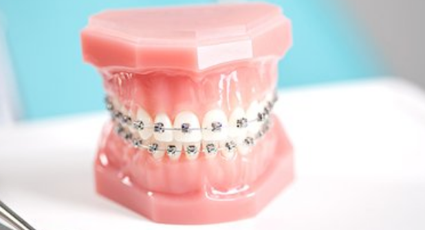 成年人是否适合进行牙齿矫正
