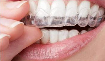 成年人牙齿矫正值得吗