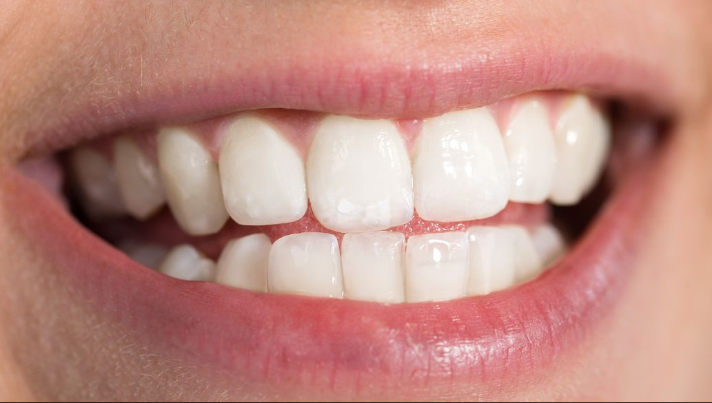 牙齿矫正费用的影响因素