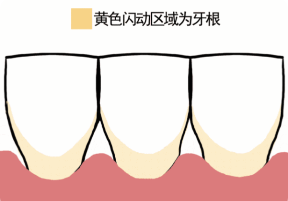 牙齿矫正对牙齿伤害大吗