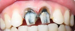 “矫正过牙齿的人会比别人更容易长蛀牙”这是真的吗?