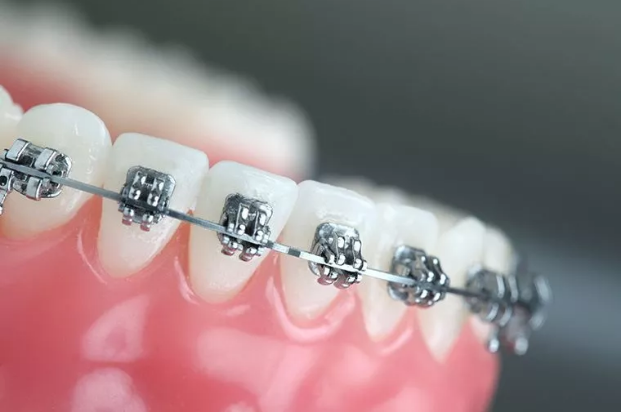 牙齿矫正是否对牙齿有伤害