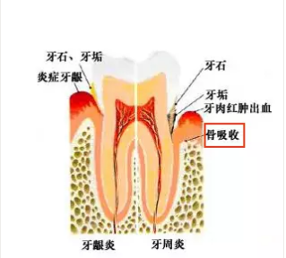 吃药只能抑菌 牙周炎如何治疗效果好?