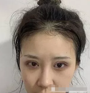 北京八大处谁做双眼皮较厉害?医生推荐附赠案例分享