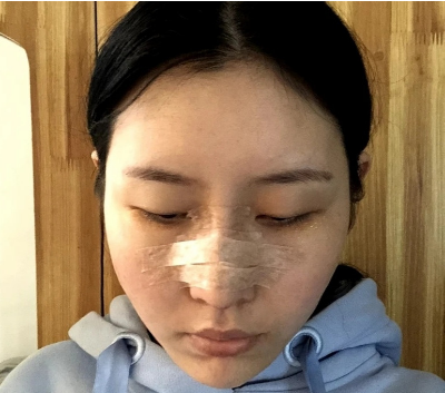 北京美莱谭章梅医生的隆鼻技术
