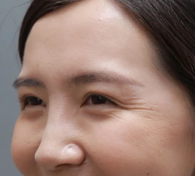 深圳美莱黄凯做热玛吉除皱