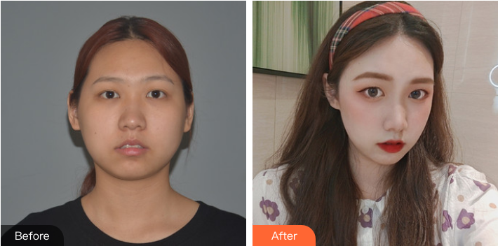 北医三院整形外科毕洪森吸脂瘦脸