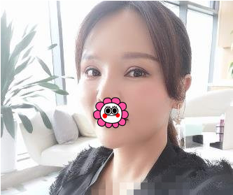 北医三院整形外科毕洪森做面部除皱