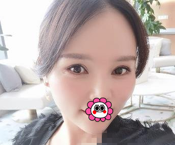 北医三院整形外科毕洪森做面部除皱