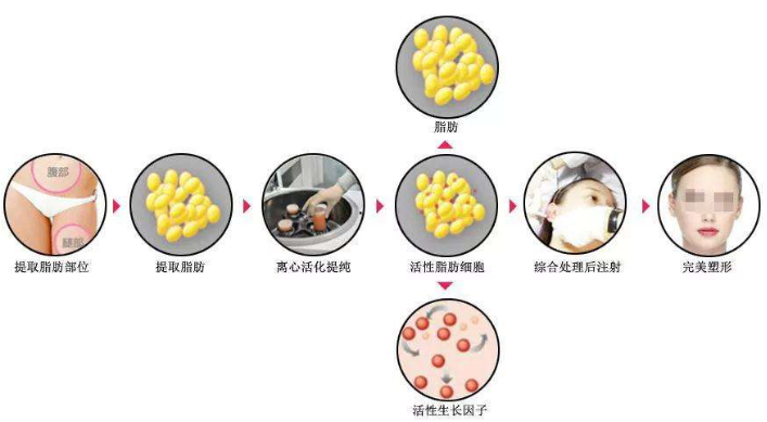 上海美联臣做鼻综合怎么样?刘双立医生隆鼻案例分享