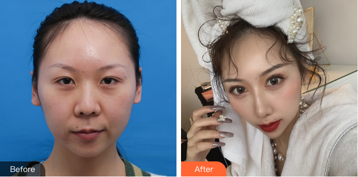 北京韩啸门诊白永辉双眼皮修复案例及方法