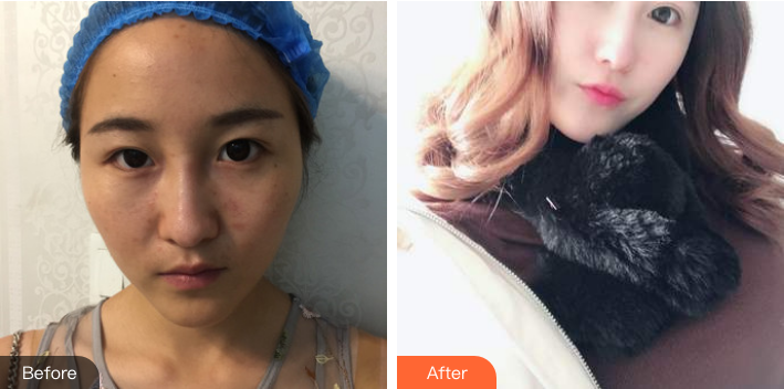 北京韩啸门诊白永辉双眼皮修复案例及方法