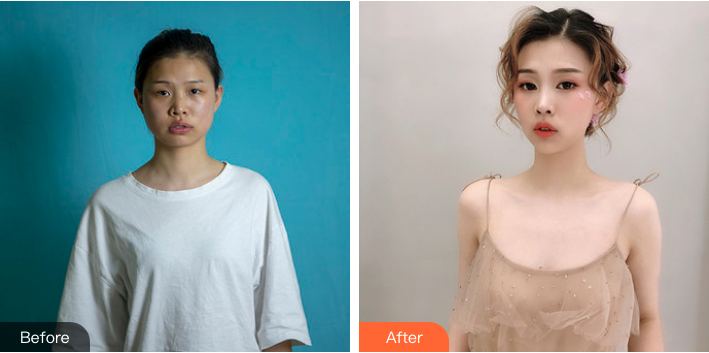 北京禾美嘉任学会面部填充+吸脂案例