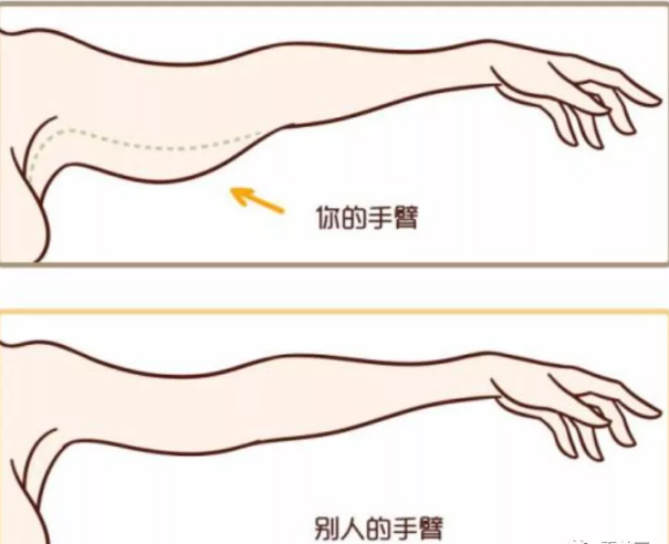 北京艺美手臂吸脂怎样,王东院长玲珑臂再造术靠谱吗,贵吗?