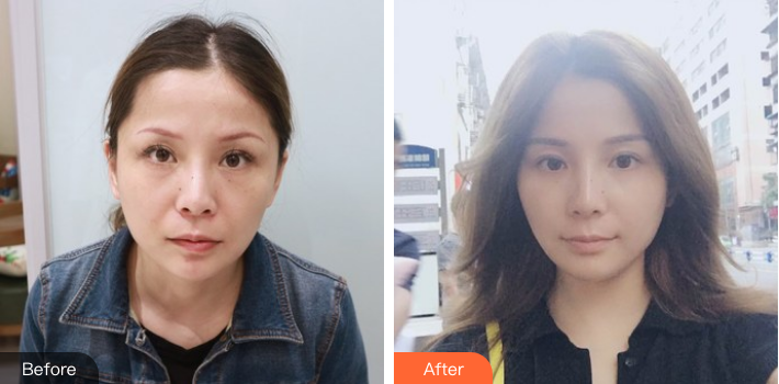 北京面部提升祝东升和李晓东哪个技术更胜一筹