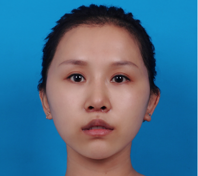 北京清木整形马梅生颧弓吸脂手术