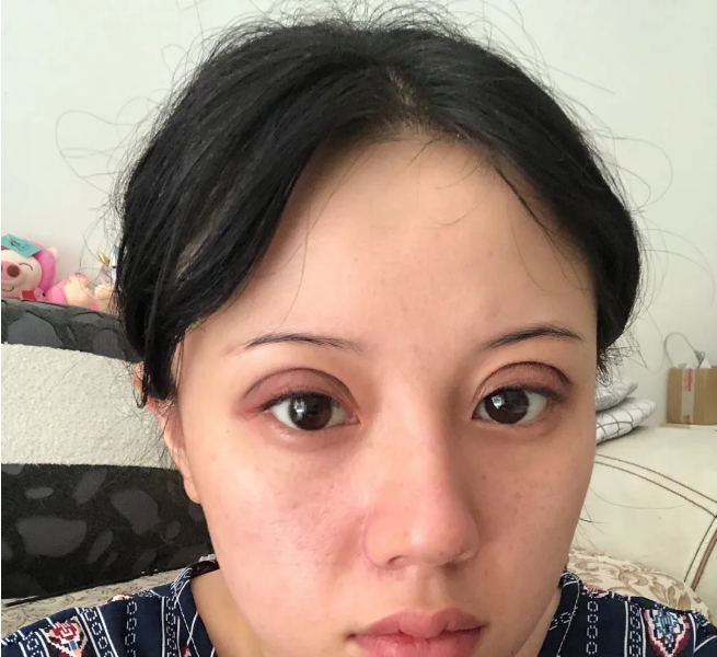 北京双眼皮修复案例分享