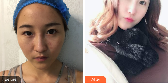 北京双眼皮修复刘风卓和王世勇哪个好