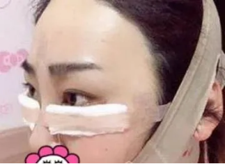成都整形美容李静如何？医生个人介绍附赠吸脂案例
