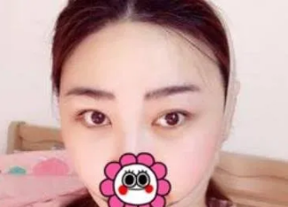 成都整形美容李静如何？医生个人介绍附赠吸脂案例