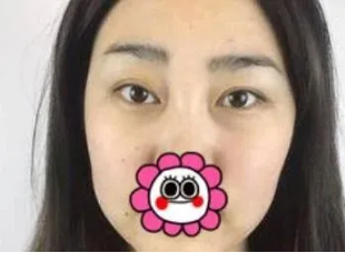 成都整形美容李静如何？医生个人介绍附赠吸脂案例