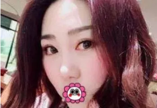 成都整形美容李静如何？医生个人介绍附赠吸脂案例