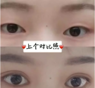 北京做的超自然全切双眼皮+开眼角，来看看效果怎么样?