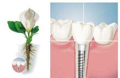 中国医大口腔医院种植牙需要多少钱？价格表一览