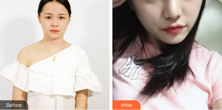北京联合丽格整形美容医院师俊莉隆鼻案例