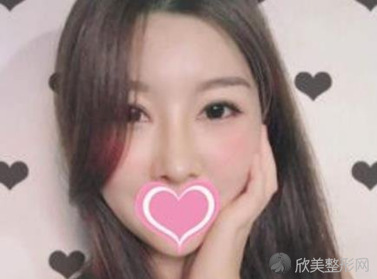 成都娇点李竞双眼皮术后案例