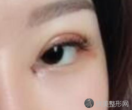 成都娇点李竞双眼皮案例