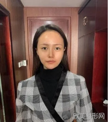 广州华美整形美容医院靠谱吗丨真人双眼皮手术案例分享~