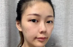 北京京民郭建玲做双眼皮技术好不好?有真实案例吗?