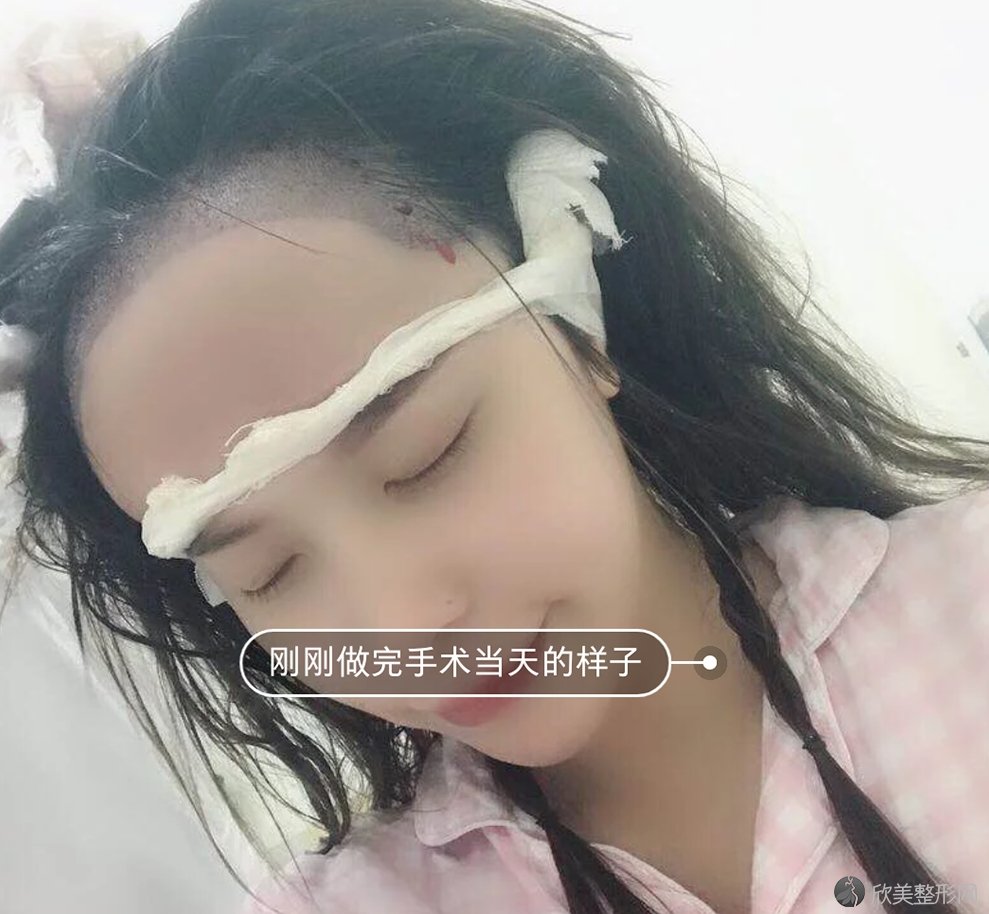 在上海江城医疗美容医院李衡华这里做了发际线移植,看上去还不错