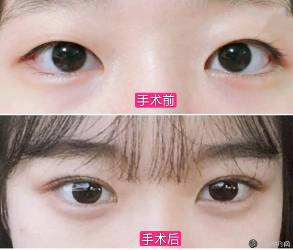 上海一美岳伟做双眼皮怎么样?案例效果图,门诊时间,价格
