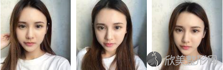 成都恒博医院李烈医生的双眼皮案例