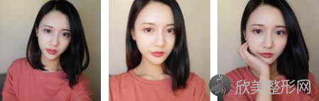 成都恒博医院李烈医生的双眼皮案例
