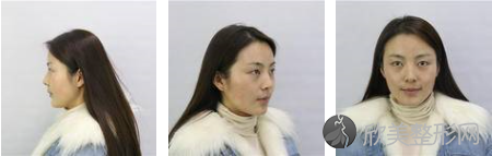 成都双眼皮做得好的是哪家？来看看我的案例吧，整个人都焕发了生机