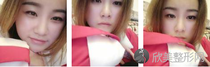 成都怡脂邓萌填充面部怎么样？来看看我得案例图片吧