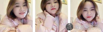 成都怡脂邓萌填充面部怎么样？来看看我得案例图片吧