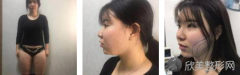 在成都恒博医院找李烈医生做了吸脂瘦脸，现在谁还会叫我胖妞？