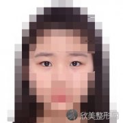 上海较好人民医院沈尊理医生做双眼皮怎么样?60天全切双眼皮恢复