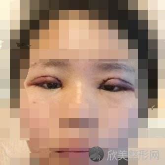 上海第一人民医院沈尊理医生做双眼皮案例