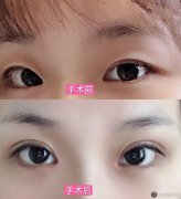 上海较好人民医院黄一雄医生做双眼皮好不好?案例,门诊预约时间