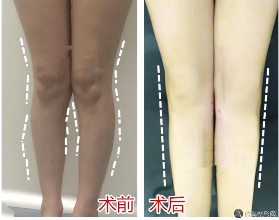 上海455医院李宇飞做脂肪移植案例