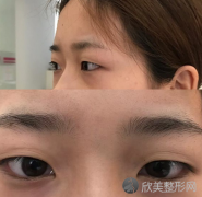 成都恒博整形美容医院李烈医生做了双眼皮，完美大眼睛不再是梦