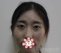 成都西区医院车红昌做双眼皮开眼角手术怎么样？案例分享
